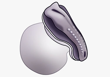 Spina Bifida
